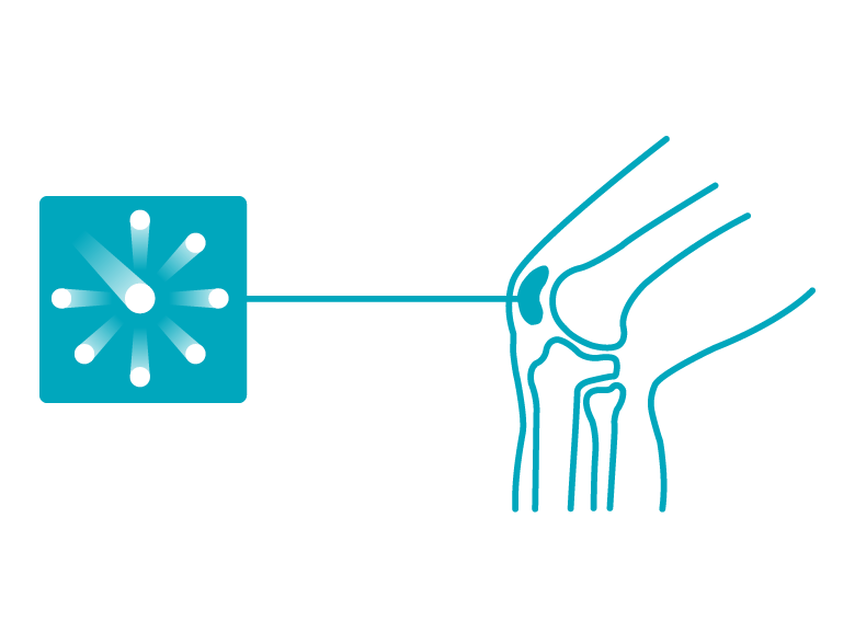 Icon for intra-articular/interstitial laser therapy: stylized laser beam penetrating joint or tissue structure.